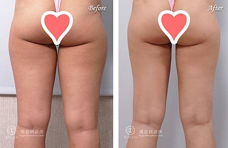 大腿抽脂,大腿抽脂案例,抽脂手術,李岳樺醫師,博恩妍
